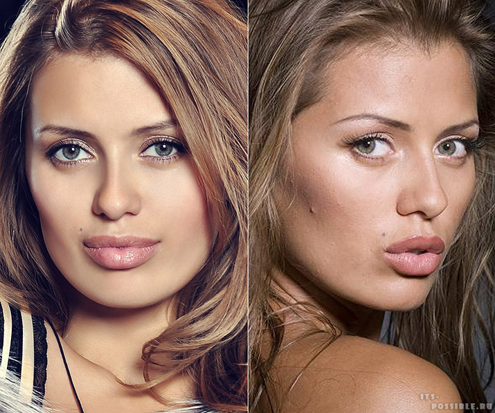 Естественно увеличенные губы фото до и после